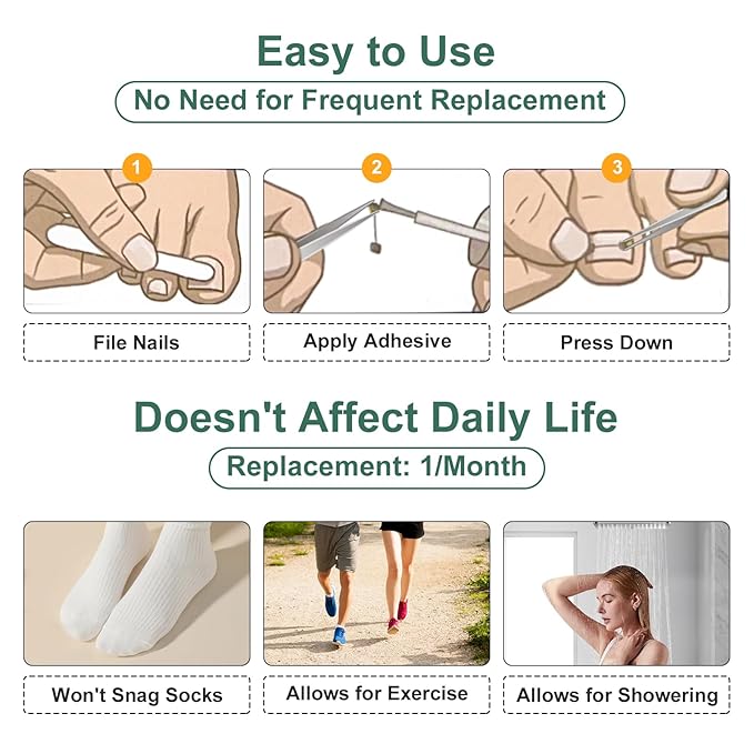 Dual Nitinol Ingrown Toenail Corrector,Ingrown Toenail Treatment,Curved Toenail Straightener,Ingrown Toenail Removal Kit,Big Toe Ingrown Toenail Tool (0.55in,0.66in)