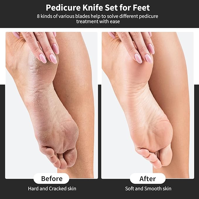 Pedicure Knife Kit, 5pcs Black Foot Dead Callus Remover Stainless Set, Professional Ingrown Toenail Steel Tools, Feet Skin Care Nail File Tool Manicure Clippers Cuticle Scraper Toe Shaver