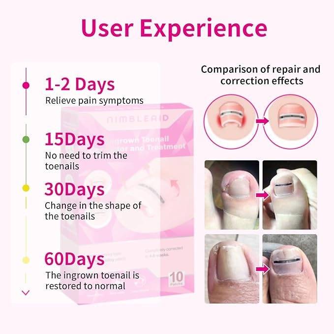 Titanium Alloy Ingrown Toenail Treatment & Corrector Kit - 3 Sizes Corrector for Men & Women Various Nail Sizes & Foot Types,Ingrown Toenail Removal Tool (10 Count-Small Size)