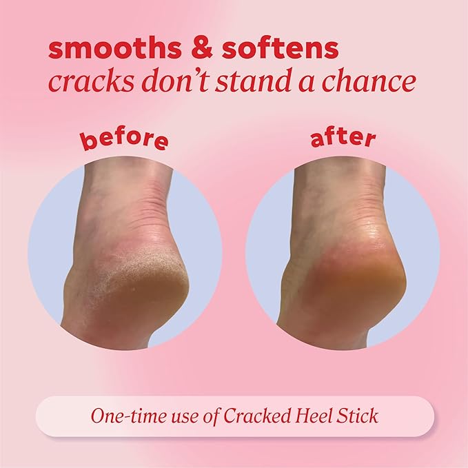 Onyx Professional Cracked Heel Repair Balm Stick for Dry Cracked Feet Treatment, Coconut Scent, 1 pack - Moisturizing Foot Balm, Rolls On, No Mess Like Foot Cream or Foot Lotion, Heel Treatment