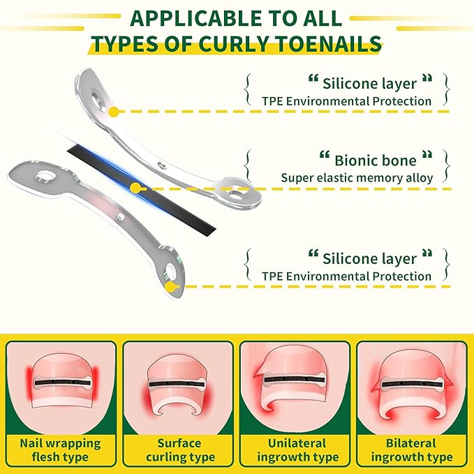 Small Size-Titanium Alloy Ingrown Toenail Treatment & Removal Kit for Quick Relief, Ingrown Toenail Removal Kit， Professional Ingrown Toenail Corrector, Ingrown Toenail Tools for Quick Relief, 10 Pcs