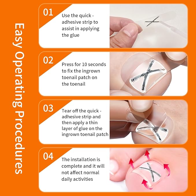 10 Patchs X-Shaped Upgrade Titanium Alloy Ingrown Toenail Corrector,At Home Ingrown Toenail Treatment for Man and Women,Ingrown Toenail Removal Kit,Curved Toenail Corrector (Large Size)