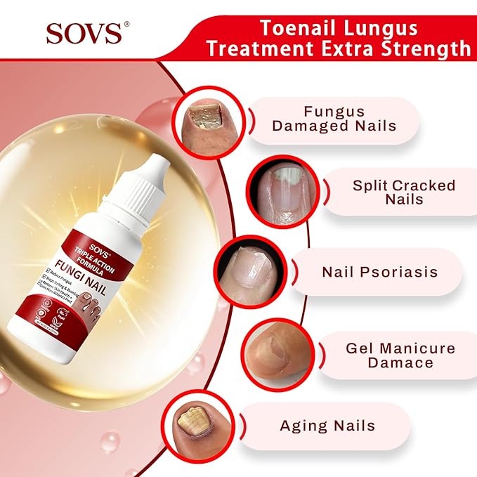 Fungi Nail Toenail Treatment,Gentle Formula, Effectively Improves Nails for a More Beautiful Appearance (1Pcs, 0.5 oz)