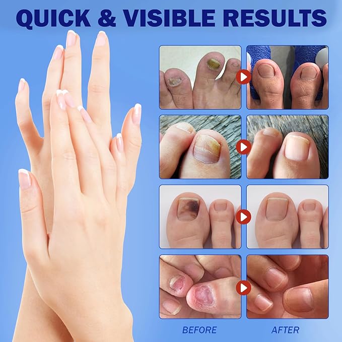 Fungal Nail Patches for Toenails, 42 Count - Nail Repair Patches with 8-Hour Adhesion, for Discolored & Damaged Toenails Care, Overnight Renewal for Men & Women