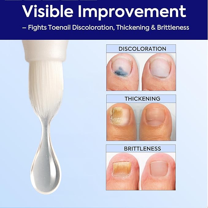 Nail Fungus Treatment Extra Strength: 25% Undecylenic Acid Formula - Toenail Fungus Treatment Kit with 5 Pens & Nail File for Ingrown Nails, Discoloration & Brittle Nails
