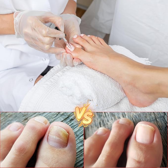 2PCS Ingrown toenail drops,Ingrown Toenail Relief,Easy Trim Ingrown Toenail Tools,Toenail Fluid With Silicone Gel Toe Caps Essential Oil Diffuser,Ingrown Toenail Reliever and Softener Kit