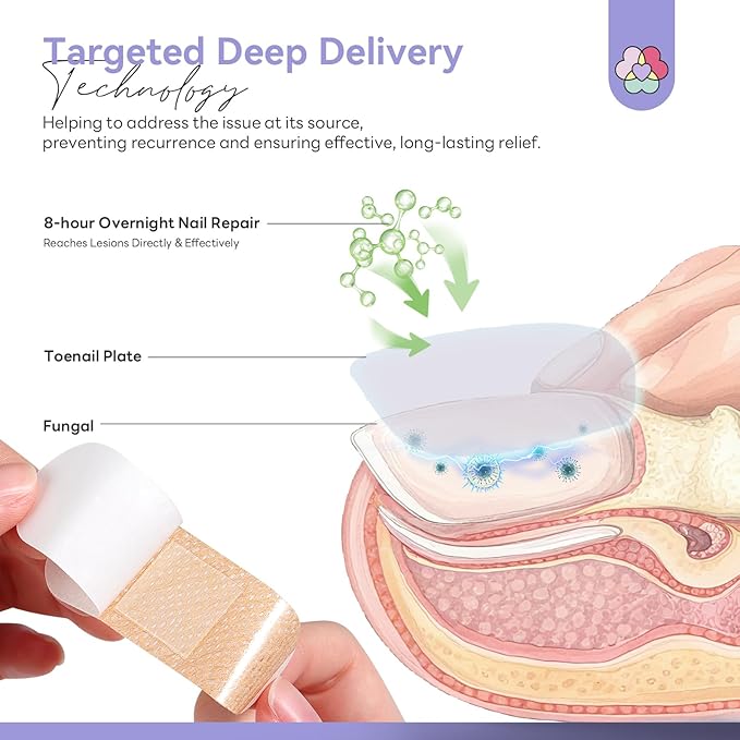 SAVILAND Extra Strength Fungal Nail Patches: 64 Patch Overnight Repair 1% Tolnaftate Toenail Treatment Nighttime Nail Renewal Restores Damaged Nails Discolored Thick Yellow Healthy Appearance
