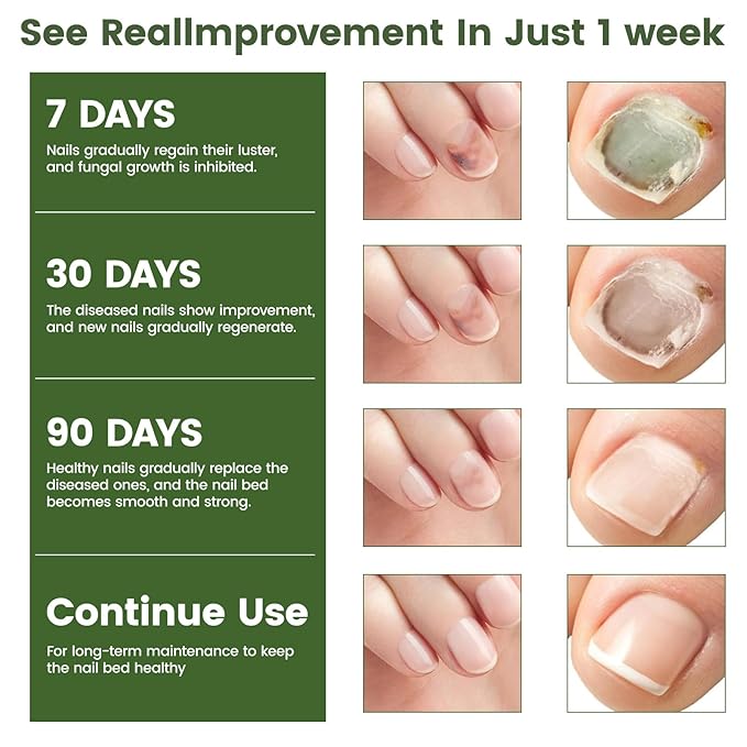 Toenail Fungus Pen, powerful Toenail fungus treatment, repairs damaged nails: yellow nails, discolored nails, thickened nails. Suitable for fingernail fungus treatment. Contains 3 nail fungus pens.