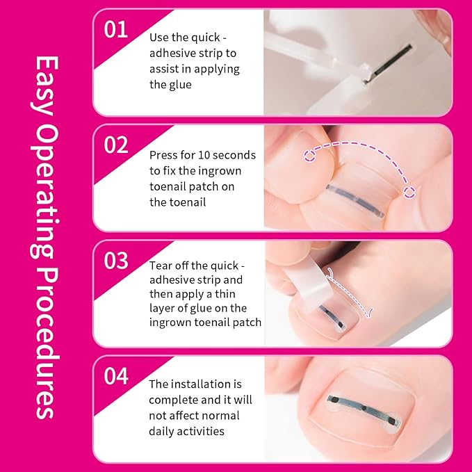 Titanium Alloy Ingrown Toenail Treatment & Corrector Kit - 3 Sizes Corrector for Men & Women Various Nail Sizes & Foot Types,Ingrown Toenail Removal Tool (10 Count-Small Size)