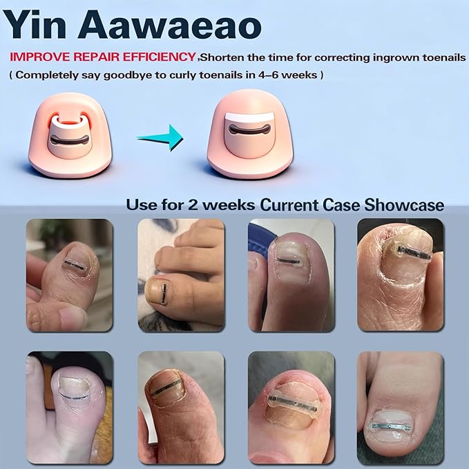 Titanium Alloy Ingrown Toenail Treatment - Professional Home Care for Curved Nails - Waterproof, Nail Tools and Ingrown Toenail Removal Kit,Ingrown Toenail Corrector(0.59/0.67in)