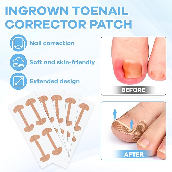 Ingrown Toenail Removal Kit with Ingrown Toenail Strips, Curved Toenails Corrector Patch, Nail File and Lifter Pedicure Tools for Women Man