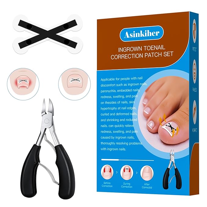 Ingrown Toenail Treatment Kit – Upgraded X-Type Titanium Alloy Corrector for Big Toe Relief, At Home Ingrown Toenail Removal Tool with Clippers and Braces