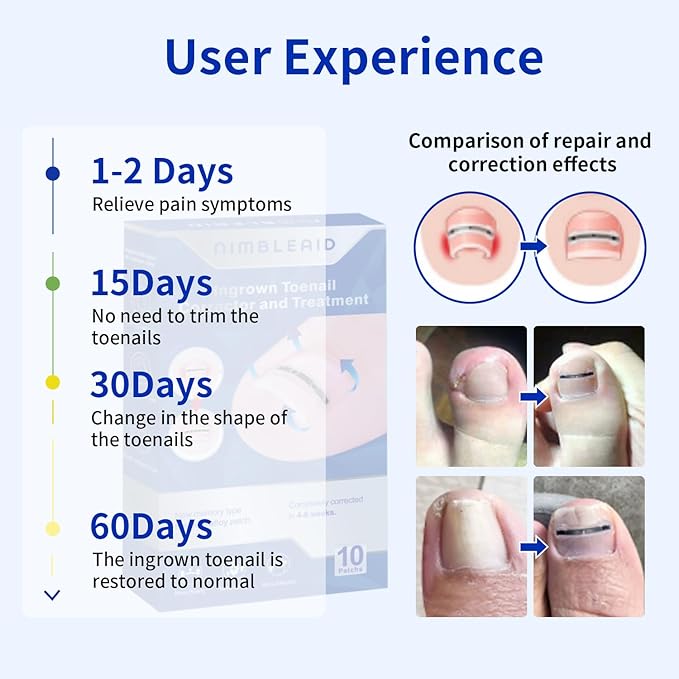Titanium Alloy Ingrown Toenail Treatment & Corrector Kit - 3 Sizes Corrector for Men & Women Various Nail Sizes & Foot Types,Ingrown Toenail Removal Tool (10 Count-Large Size)