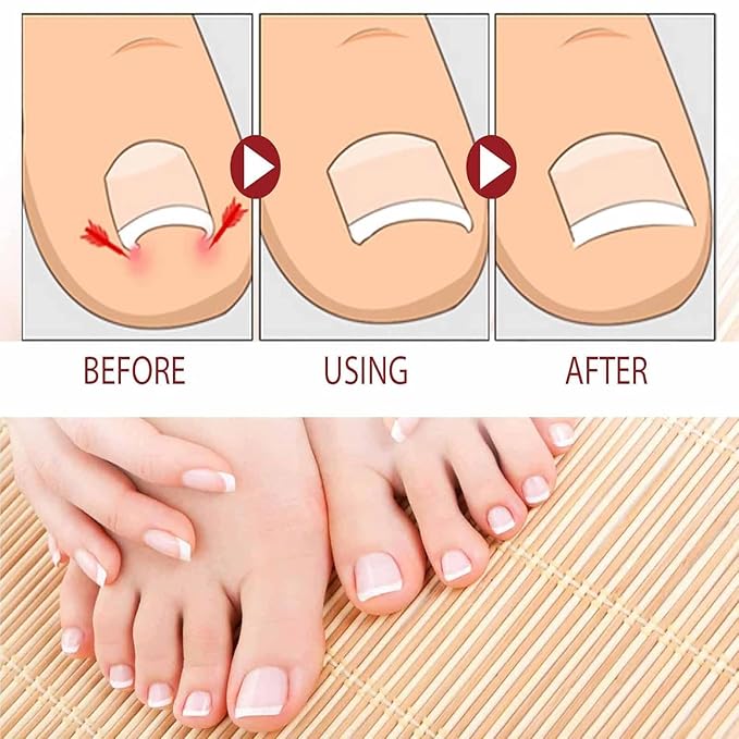 Nail Fungus Treatment Gel, Natural Nail Repair Care Gel, Nail Oil for Growth & Strength, Nail Growth Serum, Strengthening Cuticle Serum - 2pcs