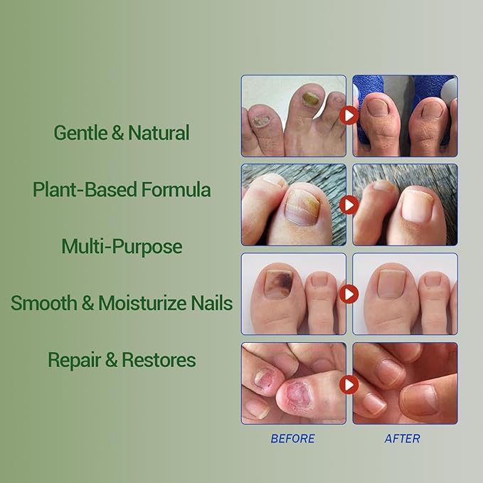 Nail Fungus Treatment Gel - Nail Growth Serum for Repair, Natural Best Repair Solution for Fingernails and Toenails, Multi-Purpose Nail Repair Oil Serum - 2 pcs