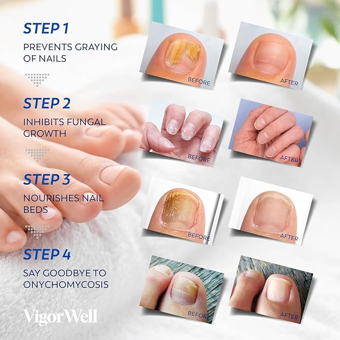 Small Nail Patches Extra Strength: 32 PCS Nighttime Hydrogel Patches for Overnight Repair - Visible Results in 8 Hours - Toenail Treatment Extra Strength