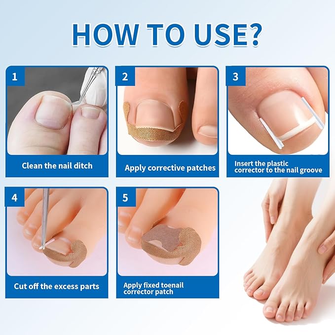 Ingrown Toenail Removal Kit - 50 Pcs Pain-Free Ingrown Toenail Corrector Strips with Toe Nail Lifter Painless File - Easy Use Ingrown Toenail Tools Kit