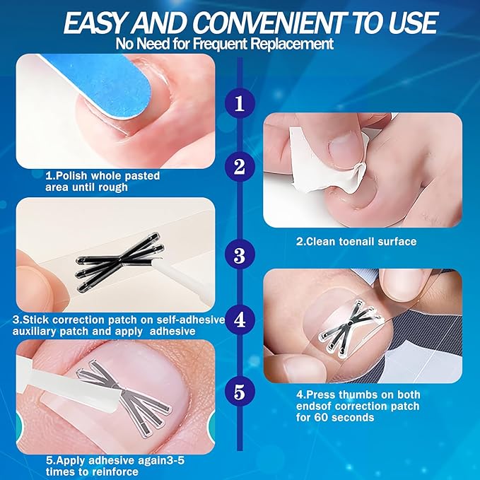 Ingrown Toenail Treatment with Upgraded 6-Angle Shape,Titanium Alloy Ingrown Toenail Corrector for Quick Relief,At-Home Ingrown Toenail Removal Kit for Toenail Curled Corrector,9Pcs