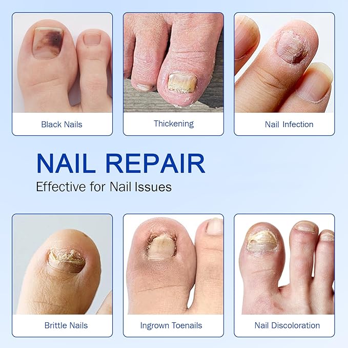 Fungal Nail Patches 21 PCS, Toenail Treatment Extra Strength 8-Hour Overnight Nail Fast Acting Repair Effortless Hydrogel Nail Care and Repair for Damaged Nails Overnight Renewal for Men and Women