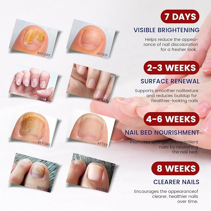 Toenail Fungus Treatment Extra Strength - 42 Pcs Fungal Nail Patches, 8-Hour Firm Adhesion, Nail Repair for Damaged Nails, Overnight Renewal for Men & Women (2 Count (Pack of 21))