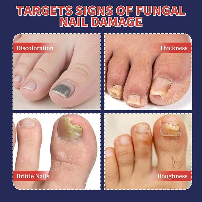 Toenail Fungus Treatment Extra Strength – 30 Pcs Fungal Nail Patches, Nail Fungus Patches for Toe Nail, Helps Improve Damaged & Discolored Nails, Overnight Renewal for Men and Women (strip)