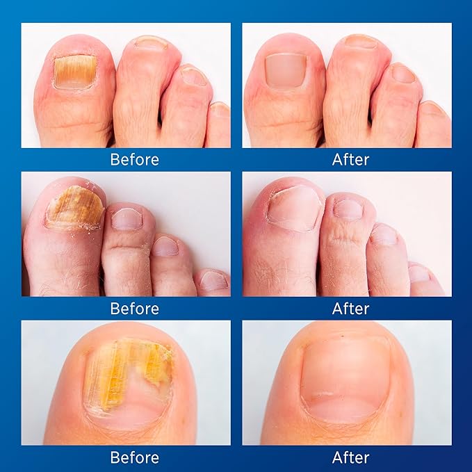 Large Nail Patches Extra Strength: 21 PCS Nighttime Hydrogel Patches for Overnight Repair - Visible Results in 8 Hours - Toenail Treatment Extra Strength