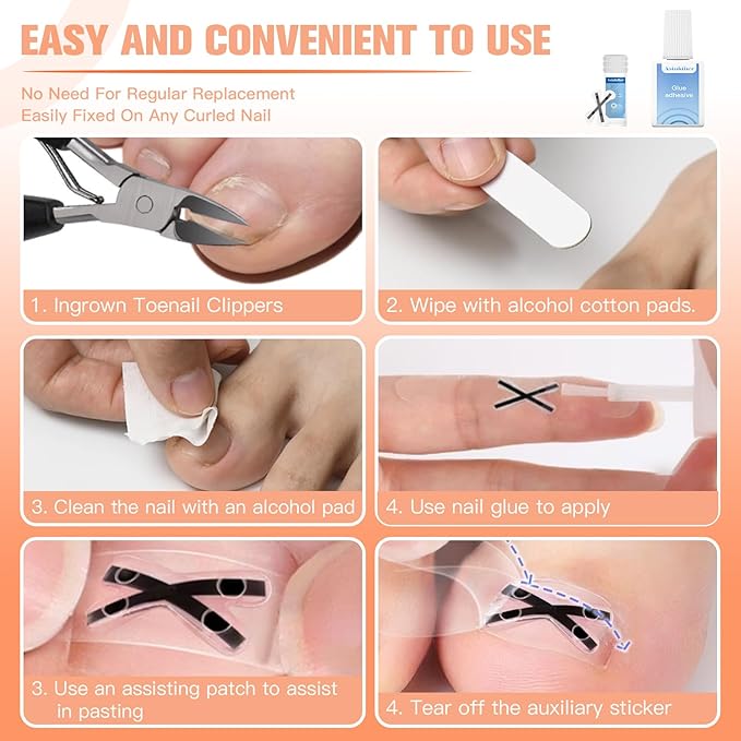 Ingrown Toenail Treatment Kit – Upgraded X-Type Titanium Alloy Corrector for Big Toe Relief, At Home Ingrown Toenail Removal Tool with Clippers and Braces