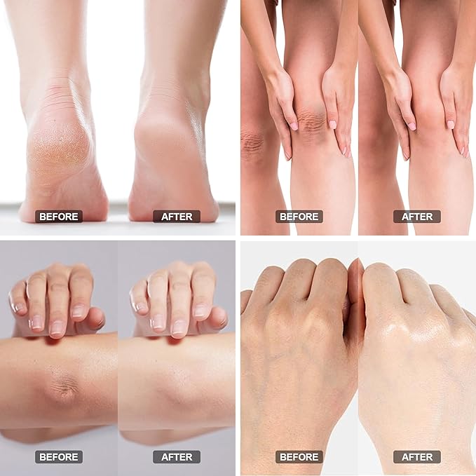 Urea Cream 42% - Foot Care for Dry Cracked Heels, Foot Lotion - With 2% Salicylic Acid, Tea Tree Oil, Shea Butter, Aloe Vera - For Feet, Hands, Heels, Elbows, Knees and More - 6 oz