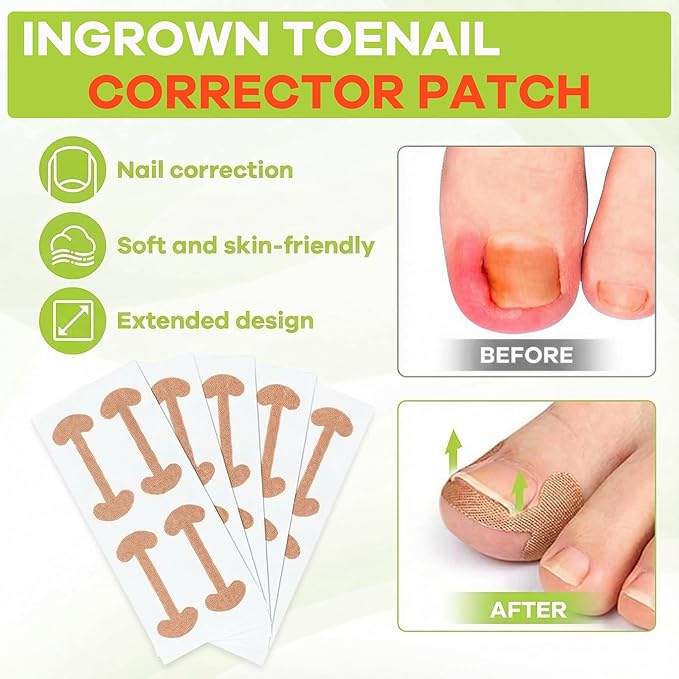 Ingrown Toenail Corrector Kit - Breathable Correction Strips with Nail Lifter Tools, Clippers & File, Toenail Relief for Edges, Home Care Solution