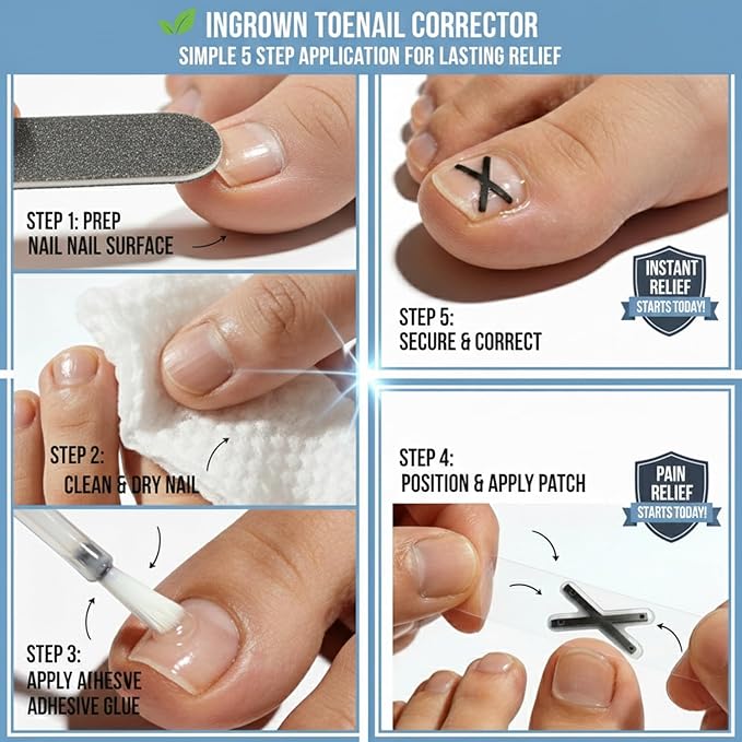 Ingrown Toenail Treatment Corrector Strips, Titanium Alloy Ingrown Nail Curve Corrector, Ingrown Toenail Tools for Home Use, 6Pcs