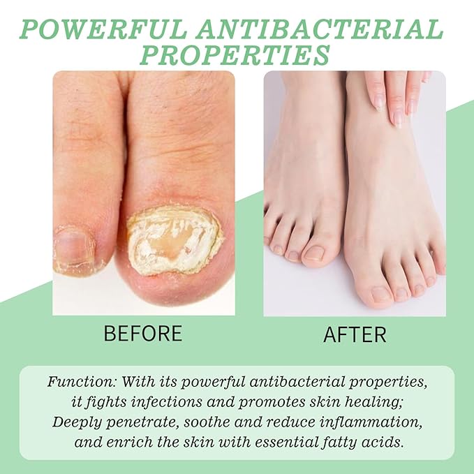Treatment Gel, Nail Growth Serum for Repair & Strengthener, Multi-Purpose Nail Repair Oil Serum, Foot Care Cream(1pcs)