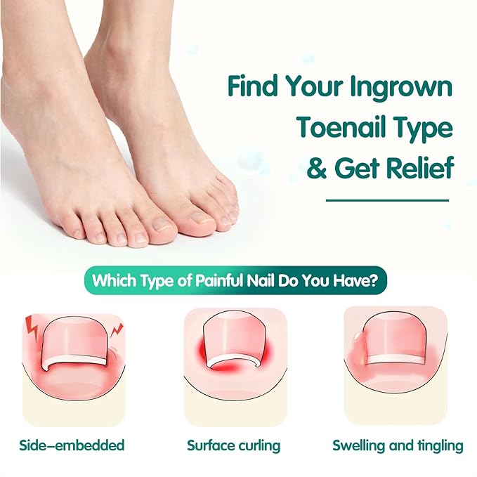 Ingrown Toenail Treatment, 60 Pcs Breathable Ingrown Toenail Strips, Painless Toenail Support Tool for At-Home Pedicure and Foot Care, Toenail Corrector Patch （60 Count (Pack of 1)）