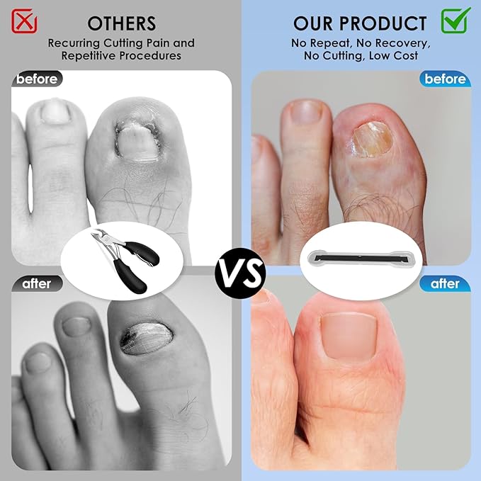 Titanium Ingrown Toenail Treatment,Ingrown Toenail Corrector for All Size Curve Correct, Nail Wraps & Nail Repair Products