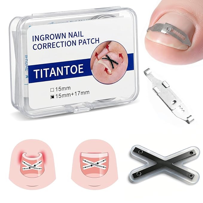 CHGRNLF Ingrown Toenail Treatment Kit, Titanium Alloy Ingrown Toenail Corrector Strips for Big Toe, Toenail Curve Corrector & Straightener for Curled Nails, At-Home Ingrown Nail Pain Relief, 6Pcs