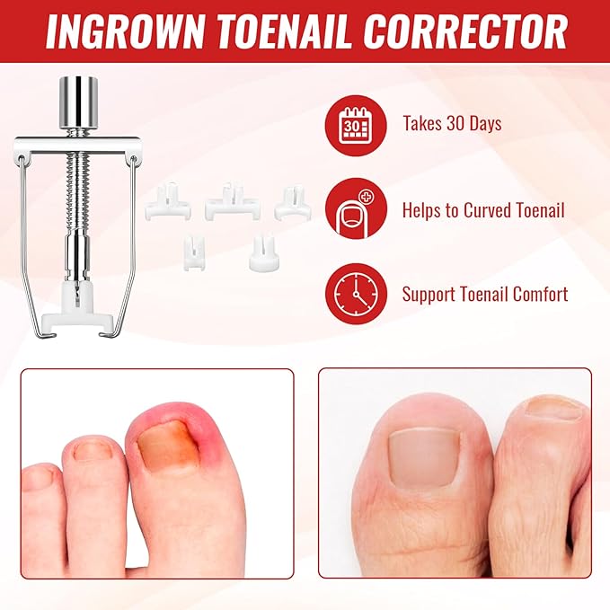 Ingrown Toenail Removal Kit, Ingrown Toenail Tool Kit with Ingrown Toenail Corrector, Ingrown Toenail Drops, Corrector Patch, Toenail Clipper, Nail File Lifter Tools