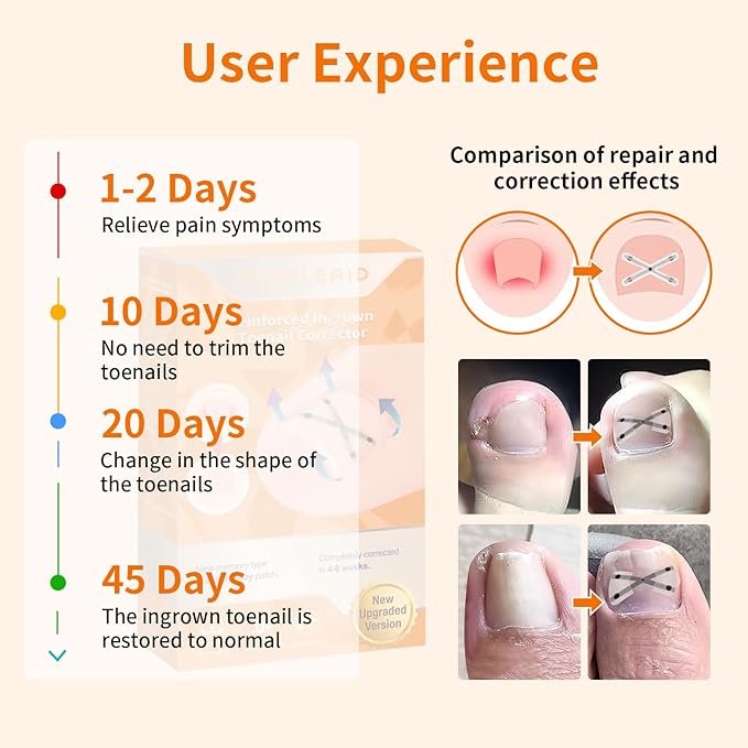 10 Patchs X-Shaped Upgrade Titanium Alloy Ingrown Toenail Corrector,At Home Ingrown Toenail Treatment for Man and Women,Ingrown Toenail Removal Kit,Curved Toenail Corrector (Large Size)