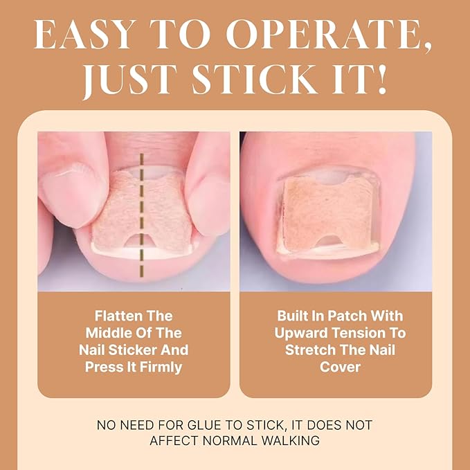 Ingrown Toenail Treatment Strips, 80Pcs Breathable Glue-Free Ingrown Toenail Corrector Patches with File, Professional Non-Slip Toenail Care Tools