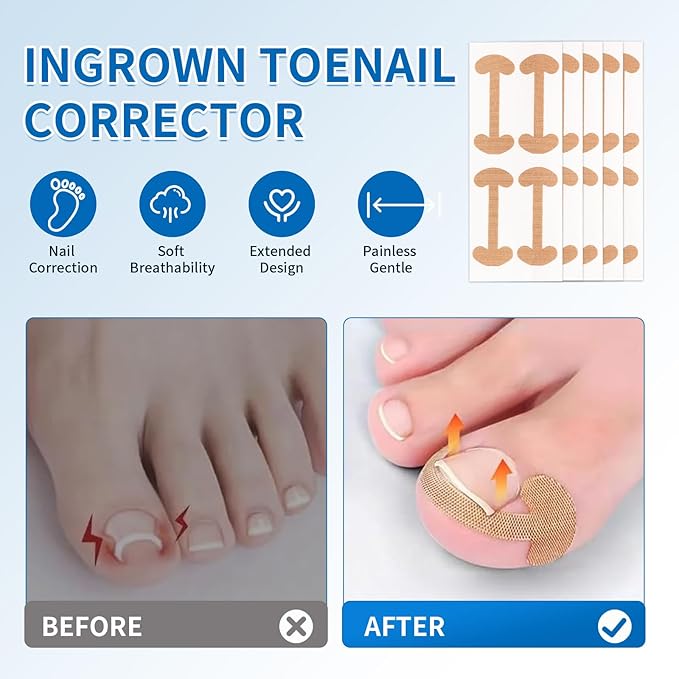 Ingrown Toenail Removal Kit - 50 Pcs Pain-Free Ingrown Toenail Corrector Strips with Toe Nail Lifter Painless File - Easy Use Ingrown Toenail Tools Kit