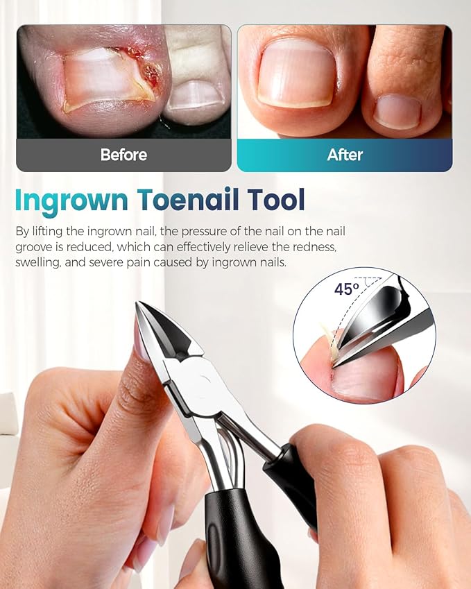 Professional Ingrown Toenail Corrector, 2-in-1 Ingrown Toenail Removal Kit with U-Shaped Strips and Correction Patch, Ingrown Toenail Clippers Tool Set- Effective Removal of Ingrown Toenails (Silver)