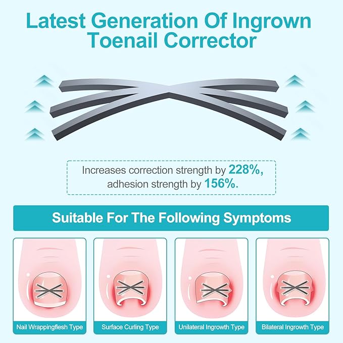 Ingrown Toenail Treatment Kit with Upgraded 6-Angle Shape,Titanium Alloy Ingrown Nail Corrector Tools with 4 Multi-Sizes,Ingrown Toe Nail Relief Remover Strips for Curved Toenail Quick Relief,8Pcs