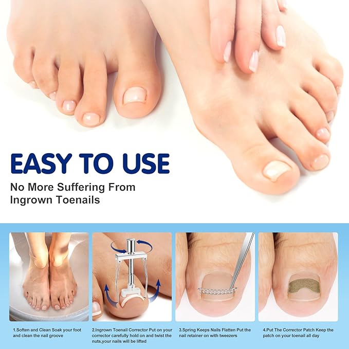 Ingrown Toenail Removal Kit, Professional Ingrown Toenail Treatment Includes Ingrown Toenail Corrector, Tweezer, 50pcs Corrector Patches, 12 Toenail Braces, 10 Ingrown Toenail Corrector Strips