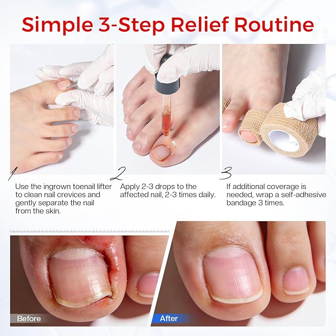 Ingrown Toenail Relief Kit: Professional 3-7 Day At-Home Ingrown Toenail Removal Drops With Ingrown Toenail Lifter & Self-Adhesive Bandage For Men Women, 30ml Softener For Hard Curved Nails