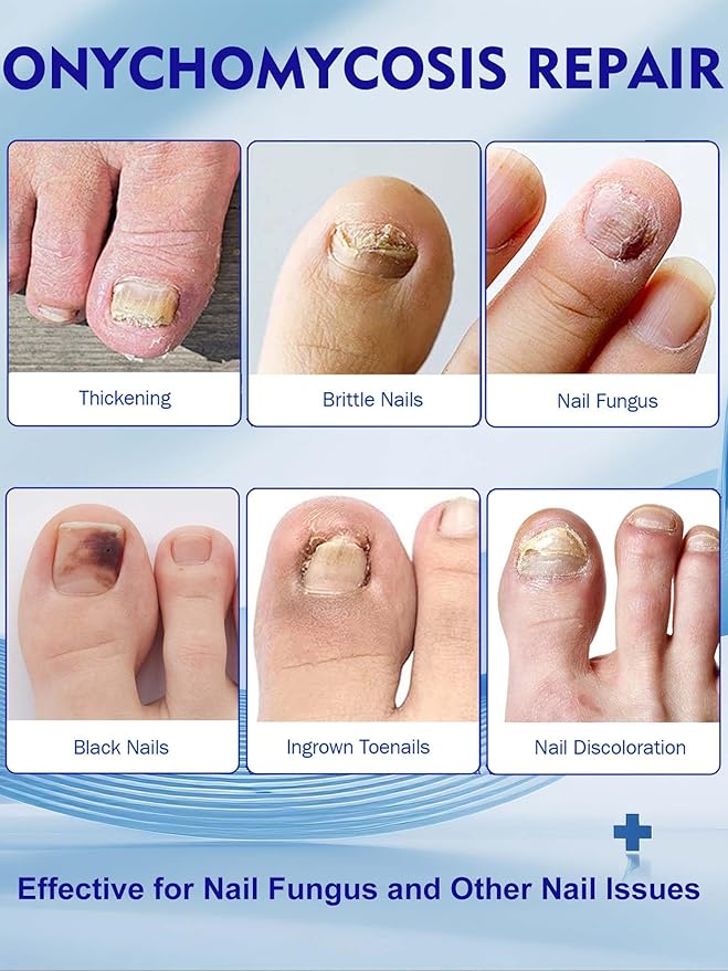 Nail Patches Toenail Treatment Extra Strength 8-Hour Overnight Nail Fast Acting Repair Effortless Hydrogel Nail Care and Repair for Damaged Nails Overnight Renewal for Men and Women (24, Medium)