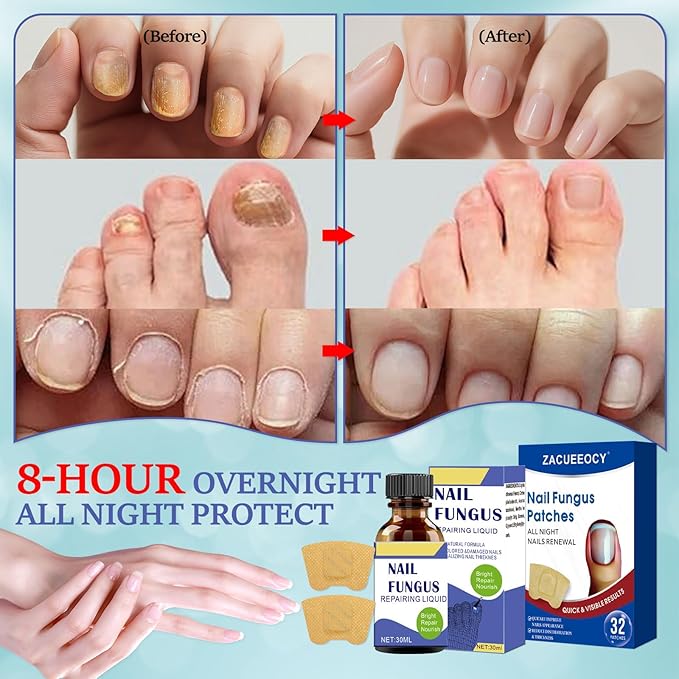 Toenail Fungus Treatment Extra Strength Kit, 30ml Nail Repair Solution and 32 Nail Renewal Patches for Damaged Thick Discolored Toenails and Fingernail
