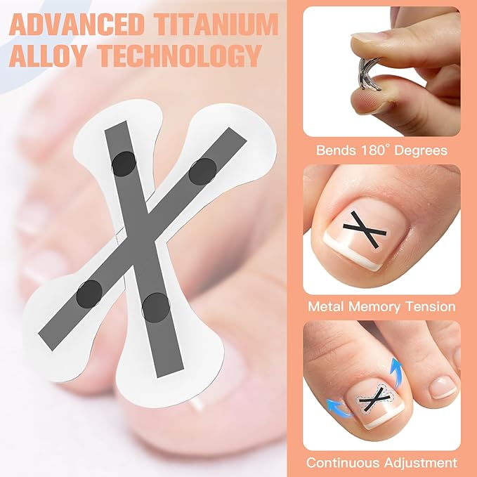 Ingrown Toenail Treatment Kit – Upgraded X-Type Titanium Alloy Corrector for Big Toe Relief, At Home Ingrown Toenail Removal Tool with Clippers and Braces