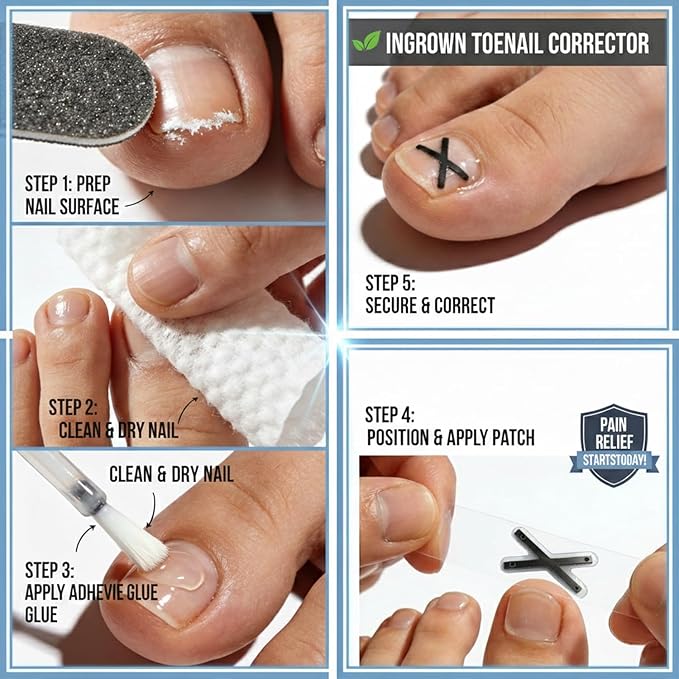 CHGRNLF Ingrown Toenail Treatment Kit, Titanium Alloy Ingrown Toenail Corrector Strips for Big Toe, Toenail Curve Corrector & Straightener for Curled Nails, At-Home Ingrown Nail Pain Relief, 6Pcs