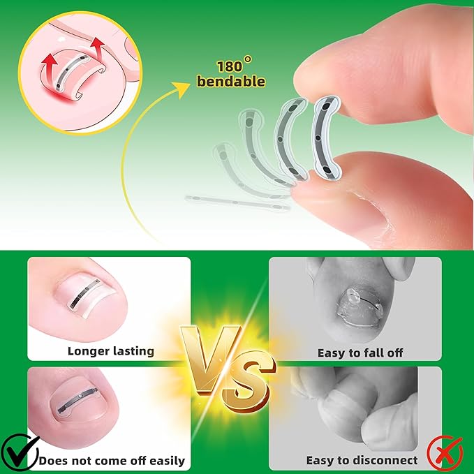 Ingrown Toenail Treatment Kit, Titanium Alloy Ingrown Toenail Removal Kit, Nails Corrector Tool & Remover Strips - Ingrown Toe Nail Quick Relief