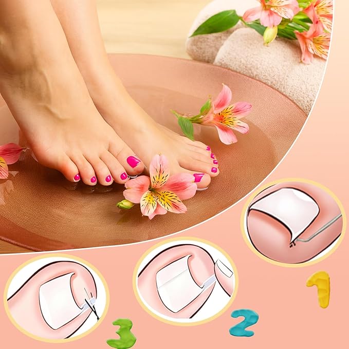 Ingrown Toenail Removal Kit,Professional Toenail Tool Kit Includes Breathable Toenail Strips, Curved Toenails Corrector Patch, Painless File and Lifter Pedicure Tools, Professional Pedicure Tool