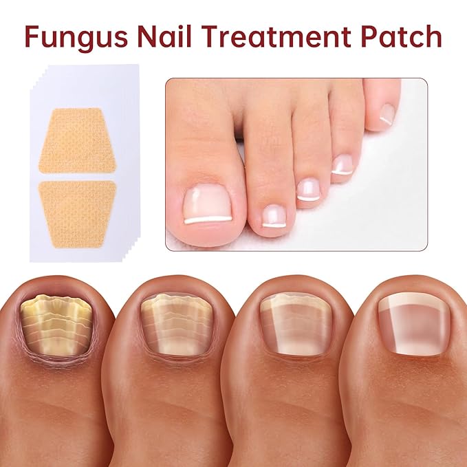 Fungus Nail Treatment Patch, 32 Pcs Foot Fungus Treatment Extra Strength, Nail Fungal Patches for Toenail, Nail Repair for Damaged Nails and Appearance of Discolored