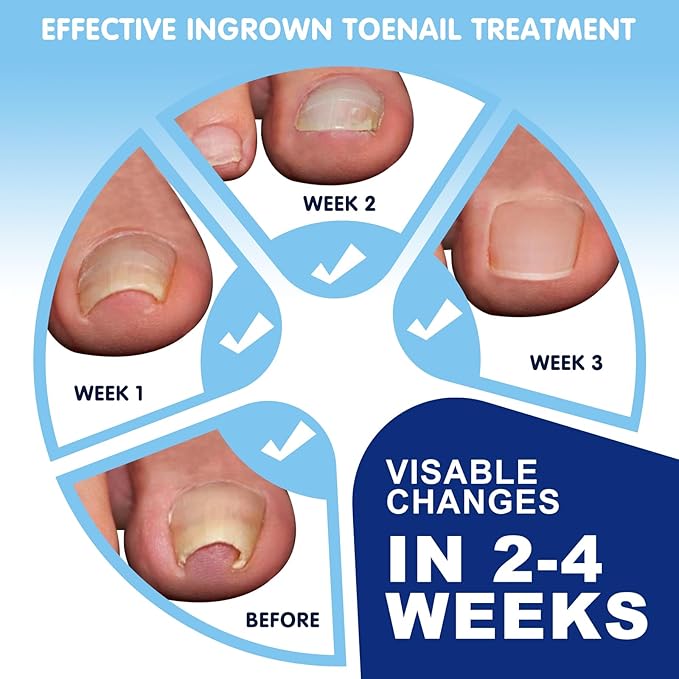 Ingrown Toenail Removal Kit, Professional Ingrown Toenail Treatment Includes Ingrown Toenail Corrector, Tweezer, 50pcs Corrector Patches, 12 Toenail Braces, 10 Ingrown Toenail Corrector Strips